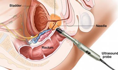Prostate Cancer Treatment in India